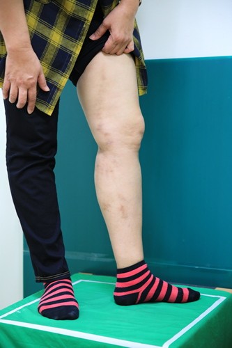 醫療與美感　超級微創雷射靜脈曲張切除手術