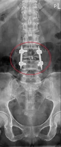 腰椎滑脫腳麻痛　脊椎微創手術幫大忙