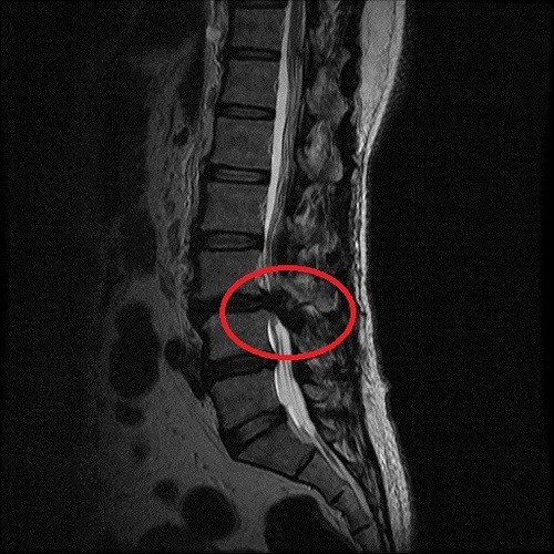 腰椎滑脫腳麻痛　脊椎微創手術幫大忙