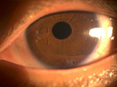 矯正視力新選擇 虹膜固定式水晶體