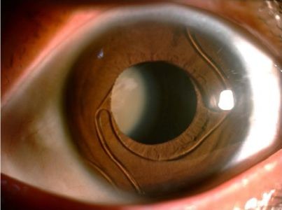 矯正視力新選擇　虹膜固定式水晶體