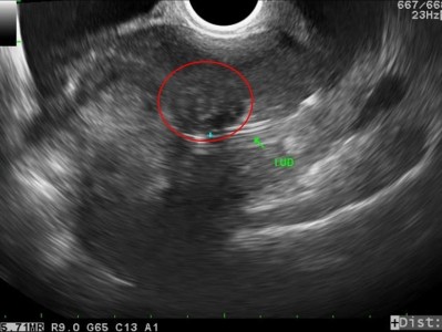 診斷性子宮腔鏡門診　早期發現深層子宮肌瘤早期治療