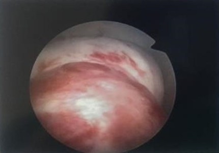 診斷性子宮腔鏡門診 早期發現深層子宮肌瘤早期治療