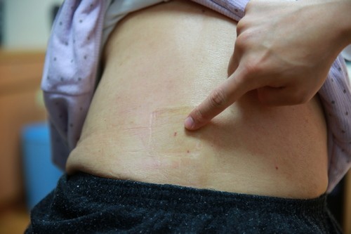 九十六歲老人家腰椎骨折 骨水泥微創手術立即見效