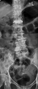 九十六歲老人家腰椎骨折 骨水泥微創手術立即見效