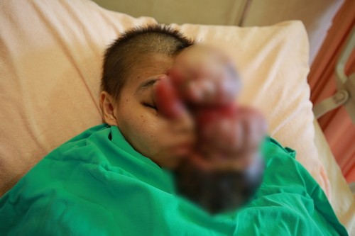 惡性皮膚纖維瘤跨海求醫 勇敢媽媽變臉重生