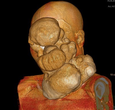 惡性皮膚纖維瘤跨海求醫 勇敢媽媽變臉重生
