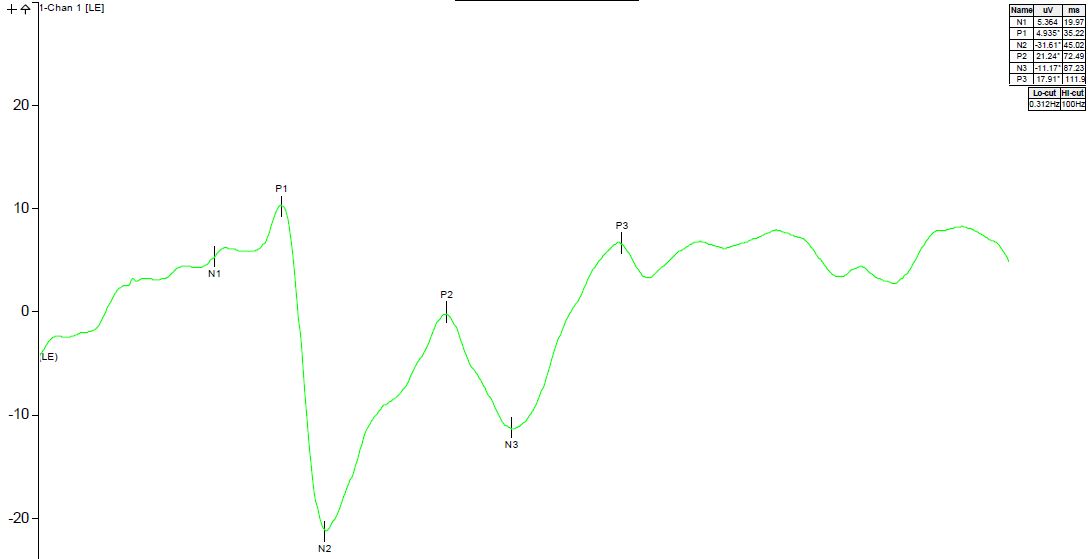 Visual evoked potential plot
