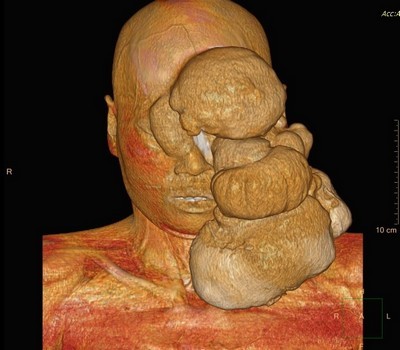 琳琳腫瘤電腦斷層 琳琳腫瘤電腦斷層