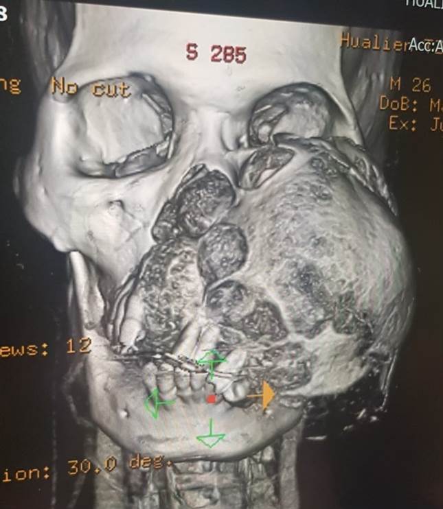 大破壞後的重建，要維持麥可左眼、鼻部呼吸、口腔功能和外觀，整形暨重建外科團隊為麥可進行眼眶顴骨複合區結構重建