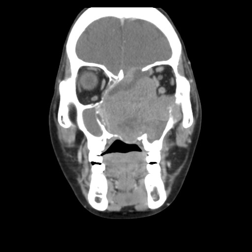 53歲的板太太確診鼻竇癌，腫瘤持續增生造成顏面變形