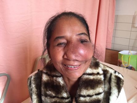 53歲的板太太確診鼻竇癌,腫瘤持續增生造成顏面變形 53歲的板太太確診鼻竇癌,腫瘤持續增生造成顏面變形