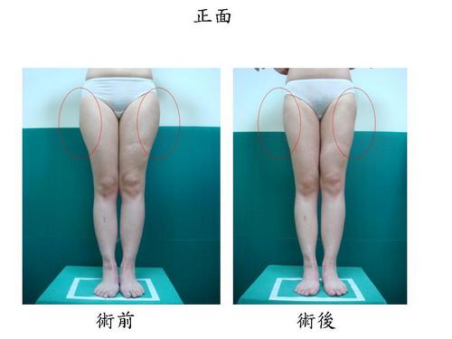 瘦小腿腓腸肌手術後